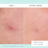 Before and after comparison of skin treatment on Day 1 and After 1 Week with a light blue background.