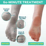 PoshPeel™ Pedi Cure